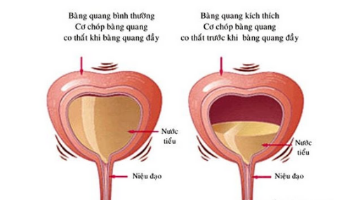 bàng quang tăng hoạt